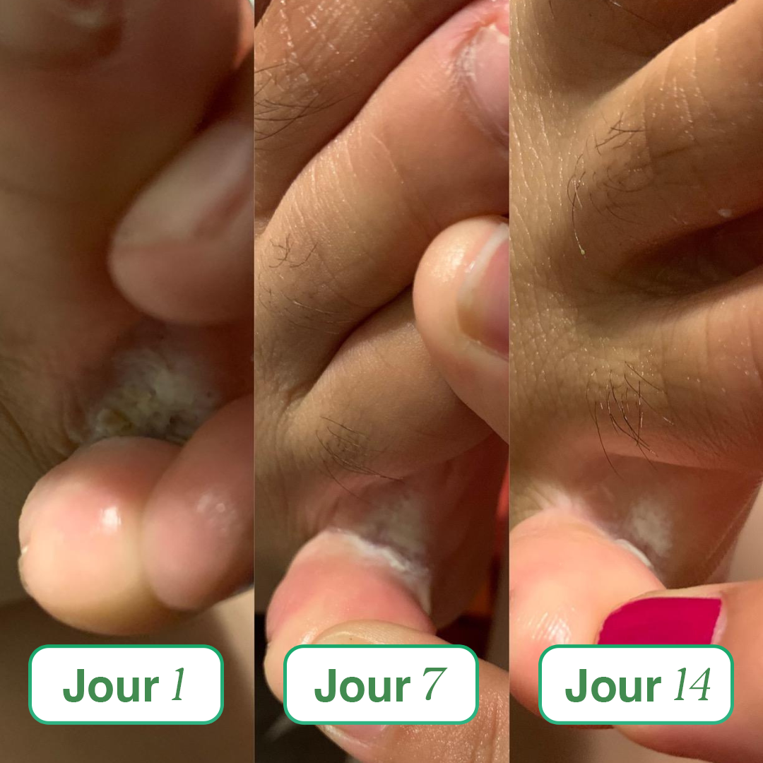 Sereya – Le savon antifongique doux pour peaux sensibles