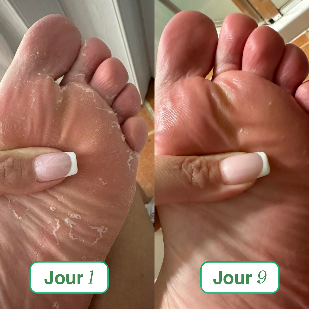 Sereya – Le savon antifongique doux pour peaux sensibles